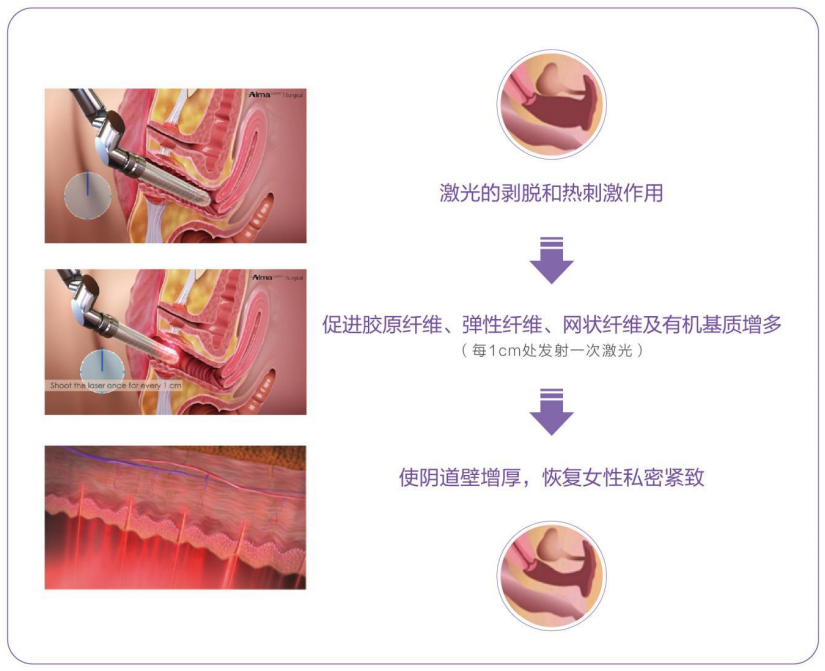 阴道松弛很要“紧”!菲蜜丽私密激光帮你做回小女人!(图8) 阴道松弛很要“紧”!菲蜜丽私密激光帮你做回小女人!(图8)